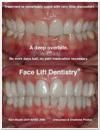 Medical research suggests that clear plastic aligners can, for many people, work as well as braces, with a shorter treatment duration. Pin By Apple Bright On Teeth Overbite Before And After Overbite Correction Overbite Braces