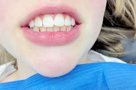 Farben Putzen Versiegeln Diese Zahnprophylaxe Bei Kindern Zahlt Die Krankenkasse Zahne Zahnbelag Zahnreinigung