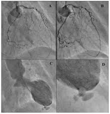 Image result for Nuclear Ventriculogram