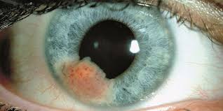 But cancer can be a source of stress for you and for. Eye Cancer American Academy Of Ophthalmology