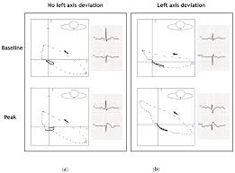 Image result for Left Axis Deviation