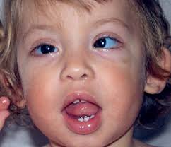 What Is Kabuki Syndrome