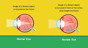 Image result for Myopia