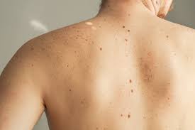 A mole is like a dozen. Why Do We Have Moles All Over Our Bodies And What Do They Do