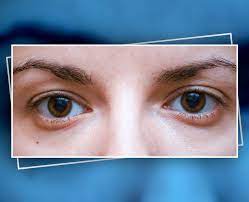 These Home Remedies To Cool Down Tired Eyes Will Do Wonders-These Home  Remedies To Cool Down Tired Eyes Will Do Wonders