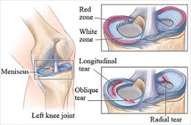 Meniscus Tear Physio Works