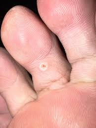 Image result for verrucae filiformes