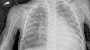 Lung cancer and emphysema are not the same things. Copd X Ray Pictures Diagnosis And More