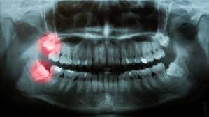 What Happens If You Don T Get Your Wisdom Teeth Removed Preventive Dentistry Timonium Dentist Lynn R Chincheck Dds