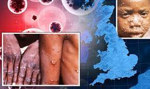 All the latest breaking news on monkey pox. Monkeypox Case Of Rare Virus Confirmed In Uk Signs And Symptoms Express Co Uk