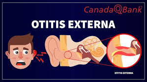 Image result for Acute Otitis Externa