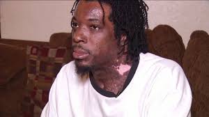 Burned Alive: 4 years later