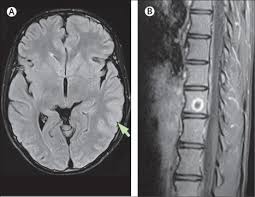 It is most often due to meningitis. Brucellosis Mimicking Herpes Simplex Virus Encephalitis The Lancet Infectious Diseases