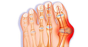 You can consider this bump on side of foot a big toe joint's arthritis. Bunion Pictures Causes Treatments