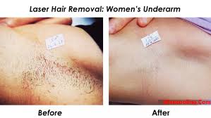 However, the length of time side effects last can depend on the practitioner performing the procedure, and the measures you take to both prepare for sessions, and care for your skin afterwards. Laser Hair Removal Side Effects Health Laser Hair Removal Hair Removal Hair