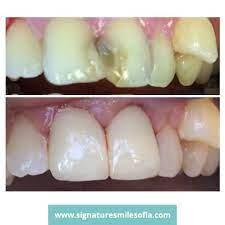 Cosmetic Dentistry Specialist Encino Before Afters Tooth Cavity Cavity On Front Tooth Dentistry