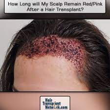 Do you want to get a hair transplant done? How Long Will My Scalp Remain Red Pink After A Hair Transplant Hair Transplant Hair Loss Cure Hair Grafting