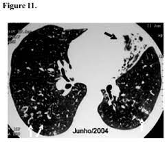 Scielo Brasil Infection With The Mycobacterium Avium Complex In Patients Without Predisposing Conditons A Case Report And Literature Review Infection With The Mycobacterium Avium Complex In Patients Without Predisposing Conditons