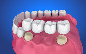 Dental Bridge For Missing Teeth Brite Dental