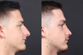 Before & After Photos