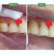 Image result for Tooth Abrasion