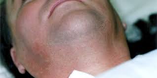 Clinically proven to remove hair effectively, vpl treatments leave your skin looking smooth, silky ipl permanent hair removal at estheclinic is totally painless thanks to the macpeel's no pain system. Vpl Transgender Hair Removal For Facial And Surgical Areas Leeds London