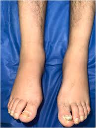 Image result for Yellow nail syndrome feet