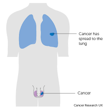 A manual examination by your doctor followed by an ultrasound will confirm a mass. Types Of Surgery Testicular Cancer Cancer Research Uk