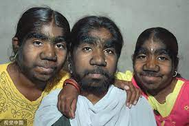 Of all the places to have werewolf syndrome, that is probably the coolest place to have it. Spanish Babies Develop Werewolf Syndrome After Medical Mix Up World Chinadaily Com Cn