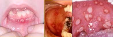 Un centro de color blanco o amarillo. Aftas Bucales Llagas En Boca Lengua Y Garganta Salud Net Ar