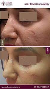 Unlike keloid scars, hypertrophic scars do not extend beyond the boundary of the original wound. Scar Revision Surgery Scar Removal Treatment Cost In Mumbai India