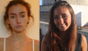 The brain actually shrinks due to a lack of nutrition with a commensurate lowering of iq. Anorexia Hair Loss Pictures