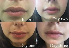 If you are very concerned, speak with your provider. I Had Lip Fillers And This Is What Happened It S Not What You Think Healthista
