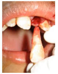 Image result for Tooth Avulsion