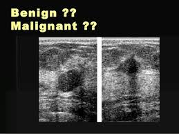 While normal, lumpy breast tissue will flatten, a cancer won't, reiland said. Breast Ultrasound