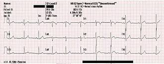 Image result for Electrocardiogram Validity