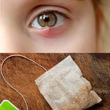 Check spelling or type a new query. How To Get Rid Of A Stye Follow These 5 Home Remedies Dr Axe