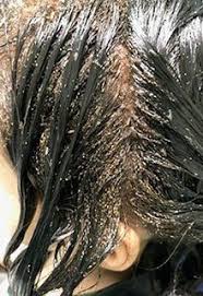 Their lifespan is less than a month. Will Head Lice Go Away Without Treatment Licedoctors