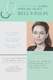 Most people with bell's palsy recover fully — with or without treatment. 13 Bells Palsy Ideas Bells Palsy Facial Nerve Bell S Palsy