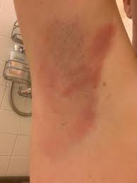 Native Deodorant Reaction Been Using Native For About 4 Months Recently Both Armpits Are Starting To Develop This Rash It Itches And Burns I Don T Want To Go Back To Regular Deodorant