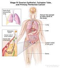 Cancer can cause many symptoms, but these symptoms are most often caused by illness, injury, benign tumors, or other problems. Ovarian Fallopian Tube Cancers Hematology Oncology Associates Of Cny