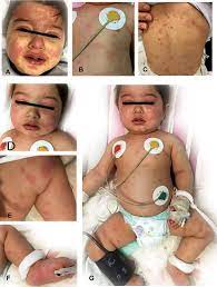 Both people already had coronavirus before the rash came up. Fever With Rash Is One Of The First Presentations Of Covid 19 In Child Imcrj