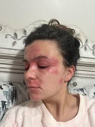 Image result for ekzema face