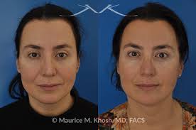 We did not find results for: Nyc Embracerf Facetite Morpheus8 Before And After Pictures Ues Facetite Photos