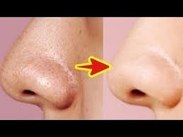 毛穴の黒ずみをゴッソリ取る方法 簡単すぎると話題に 即実践 youtube いちご鼻 スキンケア 絆創膏ダイエット