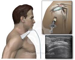 Image result for Subacromial Space Injection