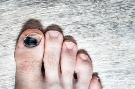 Image result for toe black diabetes
