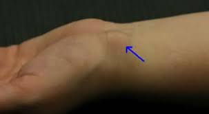 Ganglion Uberbein Zentrum Fur Handchirurgie Nurnberg