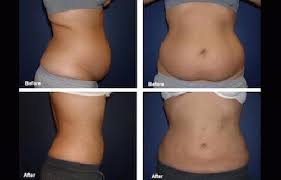 Laser Lipo Noninvasive Nonsurgical Safe Slim Summer Slim Down For Summer With Laser Lipo Safe Liposuction Before And After Liposuction Laser Lipo
