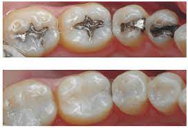 If cost is a concern, you can always sign up with a dental discount plan or ask if your dentist offers cash discounts. Composite Fillings In Houston How Much Do They Cost